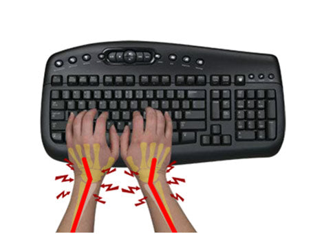 Keyboard induced ulnar deviation